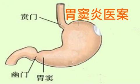 刘某胃窦炎案——李冠杰 