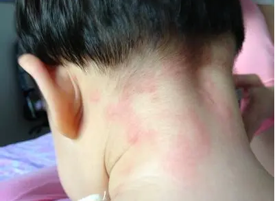慢性荨麻疹医案——王小艳 