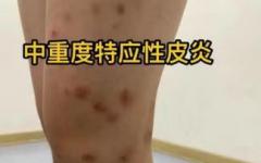 儿童重度特应性皮炎彻底治愈！速进文章查看详情！